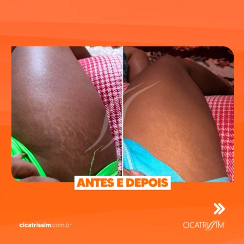Antes e depois estrias 1