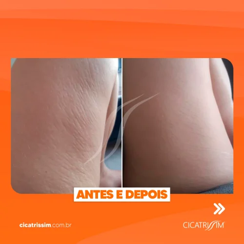 Antes e depois estrias 2