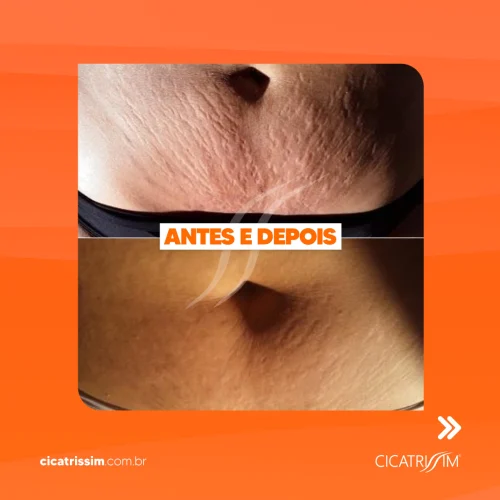 Antes e depois estrias 3