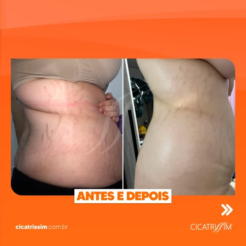Antes e depois estrias 5