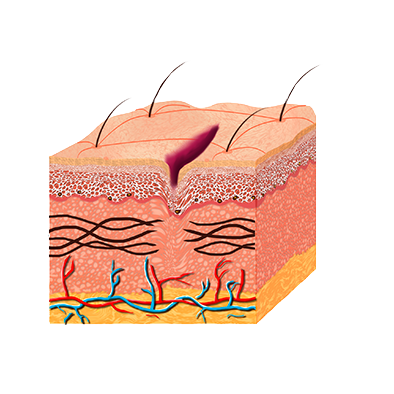 Antes - Fibras Rompidas